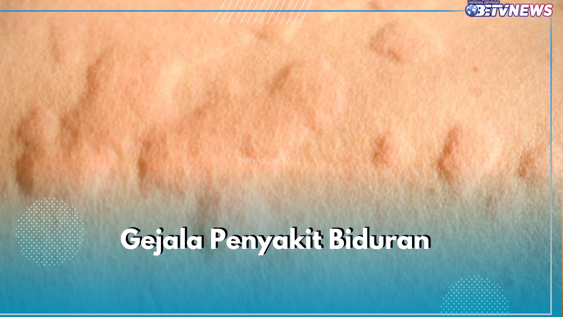 Bukan Cuma Bentol, Ini 5 Gejala Penyakit Biduran yang Perlu Kamu Ketahui