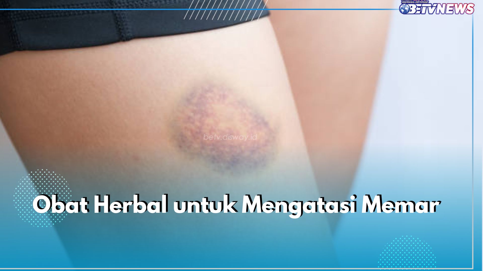 6 Obat Herbal untuk Atasi Memar pada Tubuh, Efektif Tanpa Efek Samping!