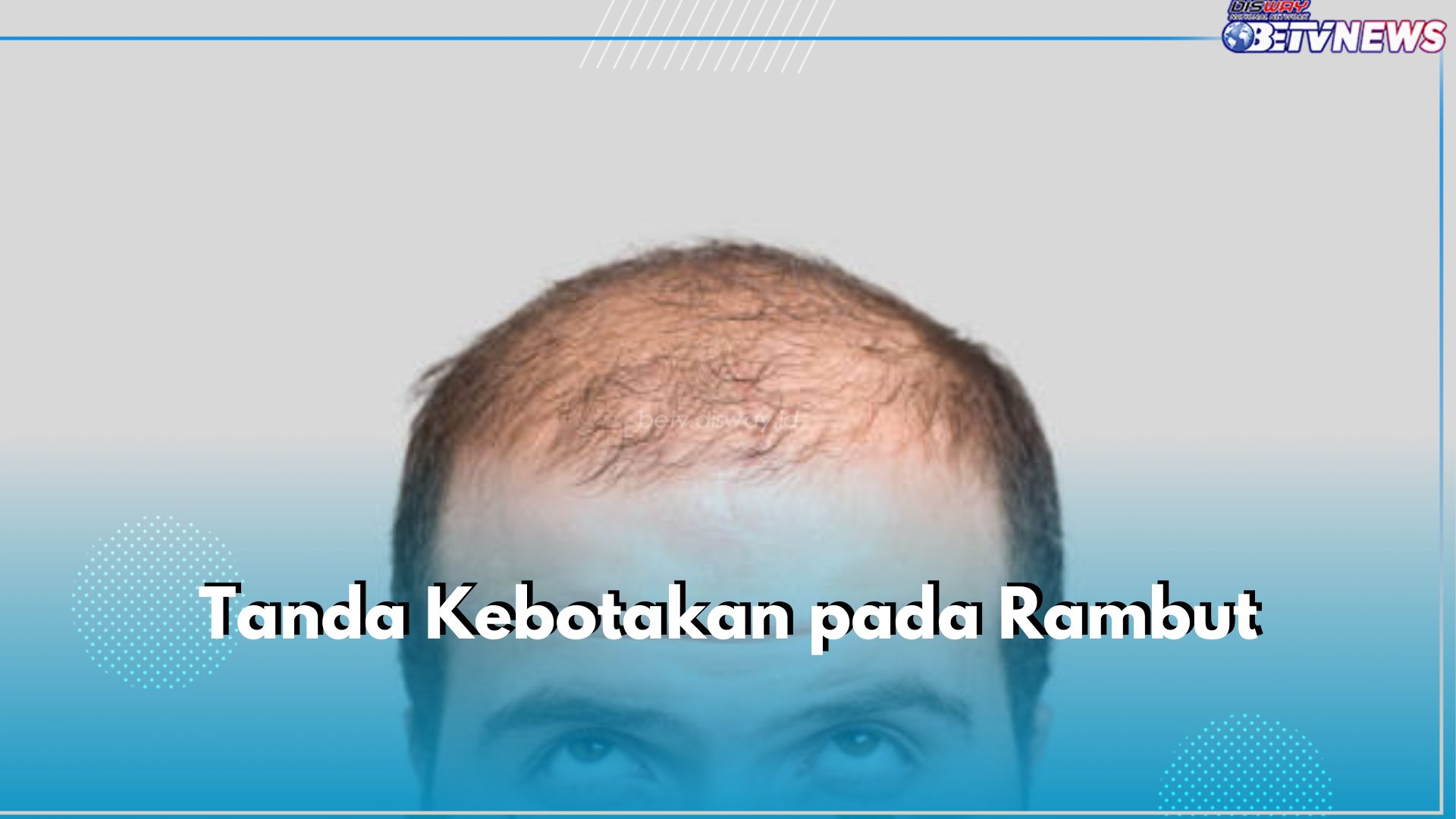 Wajib Tahu! Ini 7 Tanda Kebotakan pada Rambut, Atasi Sebelum Terlambat