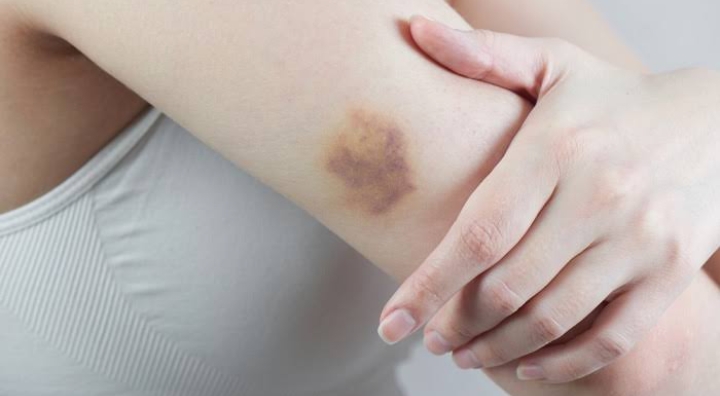 Terbukti Ampuh! Cek Disini Pilihan Obat Memar dengan Bahan Herbal Alami