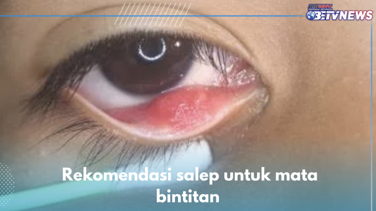 5 Rekomendasi Salep untuk Obati Mata Bintitan, Ada Cendo Xitrol hingga Cendo Fenicol