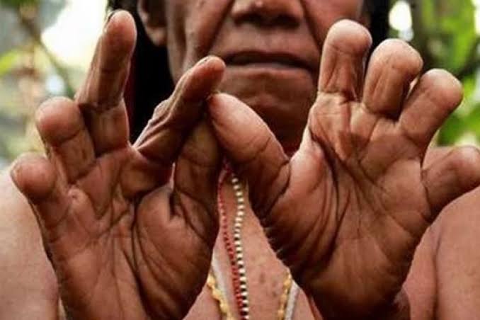 Mengenal Tradisi Ekstrem Potong Jari di Papua, Sebuah Simbol Kesetiaan Wanita yang Mendalam