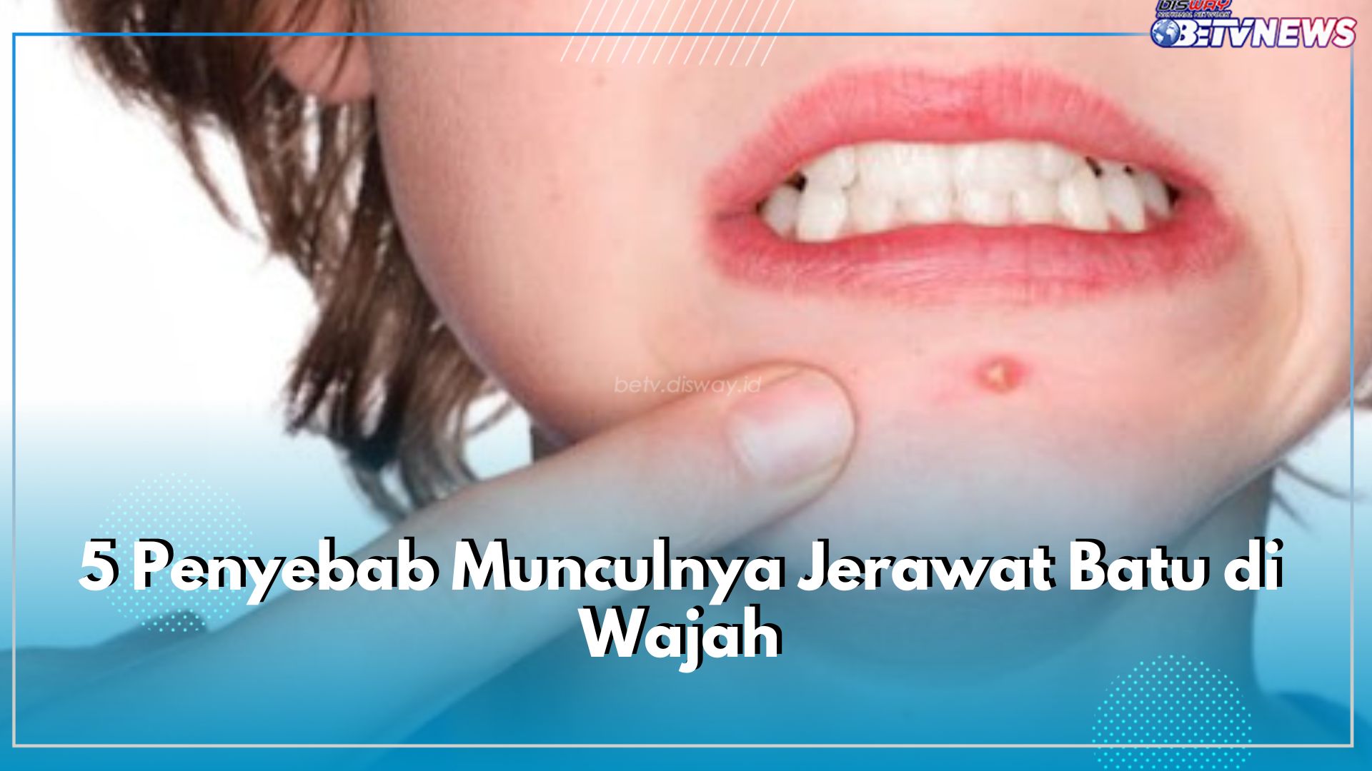 Inilah 5 Penyebab Munculnya Jerawat Batu di Wajah, dari Stres hingga Perubahan Hormon