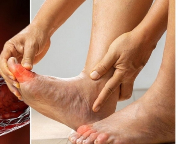 Kaki Terasa Nyeri? Waspada Ciri-ciri Kolesterol Tinggi, Ini Penjelasannya!