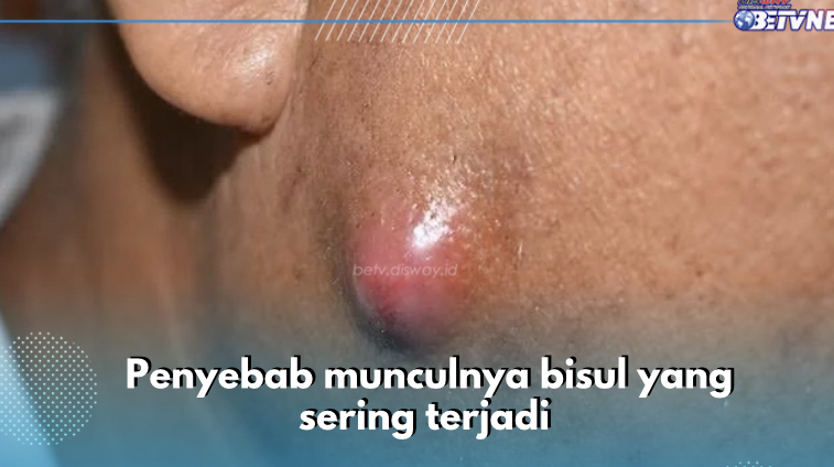 Selain Telur, Ini 8 Penyebab Lain Munculnya Bisul, Cek Sekarang