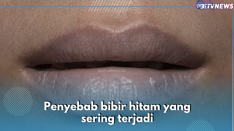 Anemia Defisiensi Besi Sebabkan Bibir Jadi Hitam,Cek 7 Penyebab lainnya di Sini