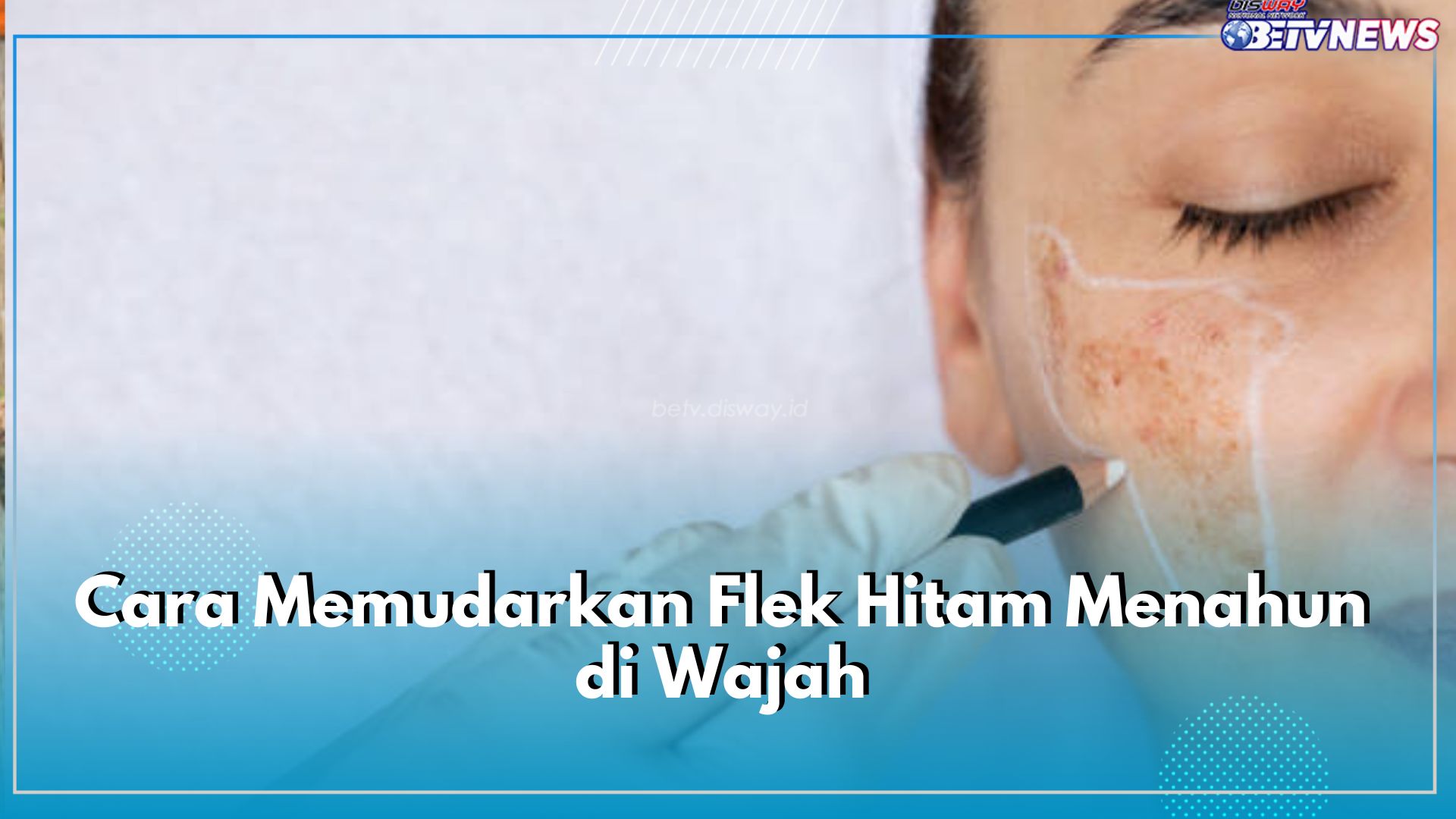 Punya Flek Hitam Menahun? Pudarkan Menggunakan Bahan Alami, Ini 5 Cara Mengatasinya!