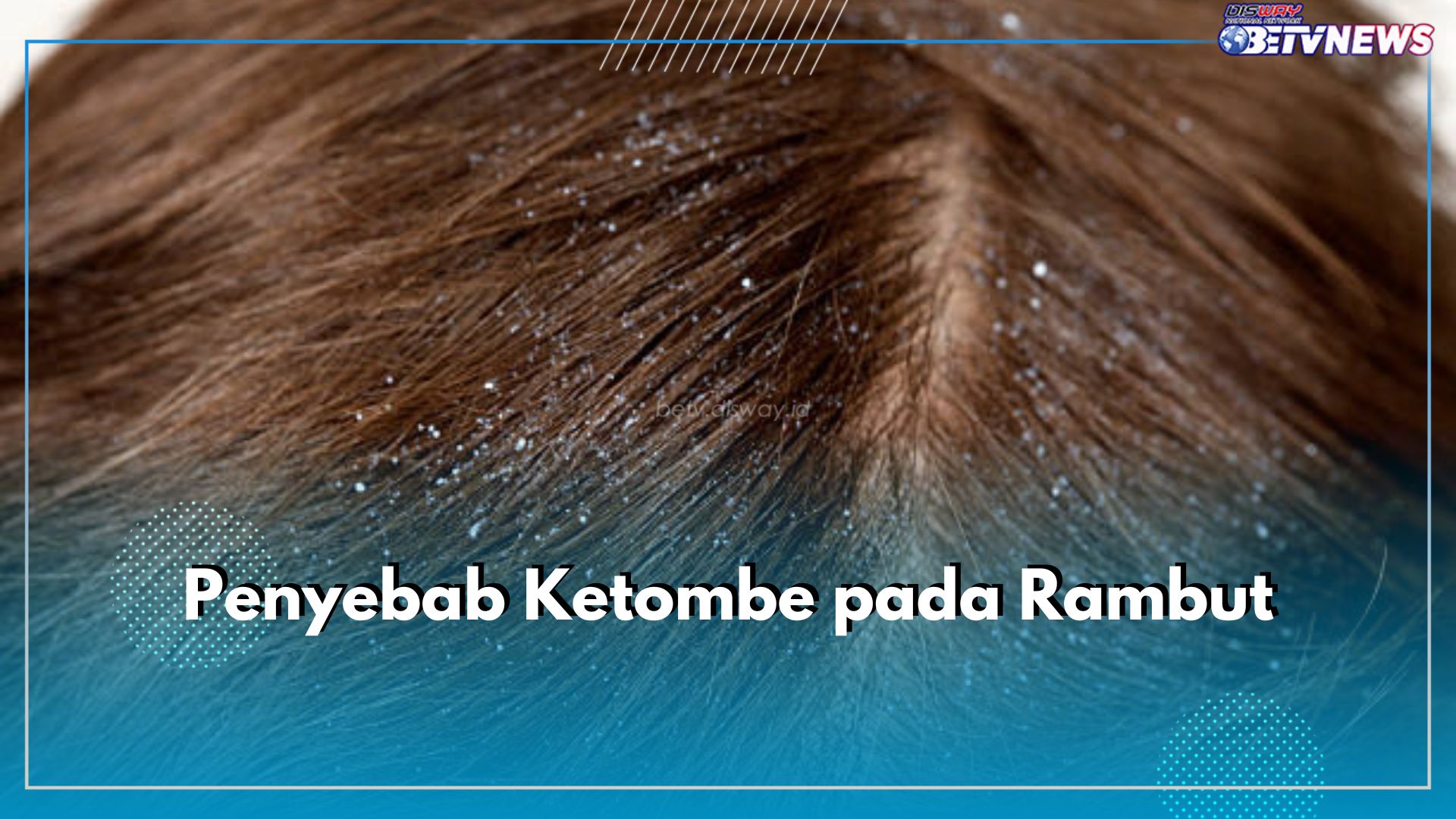 Kenali 5 Penyebab Ketombe Pada Rambut Ini, Salah Satunya Jarang Keramas