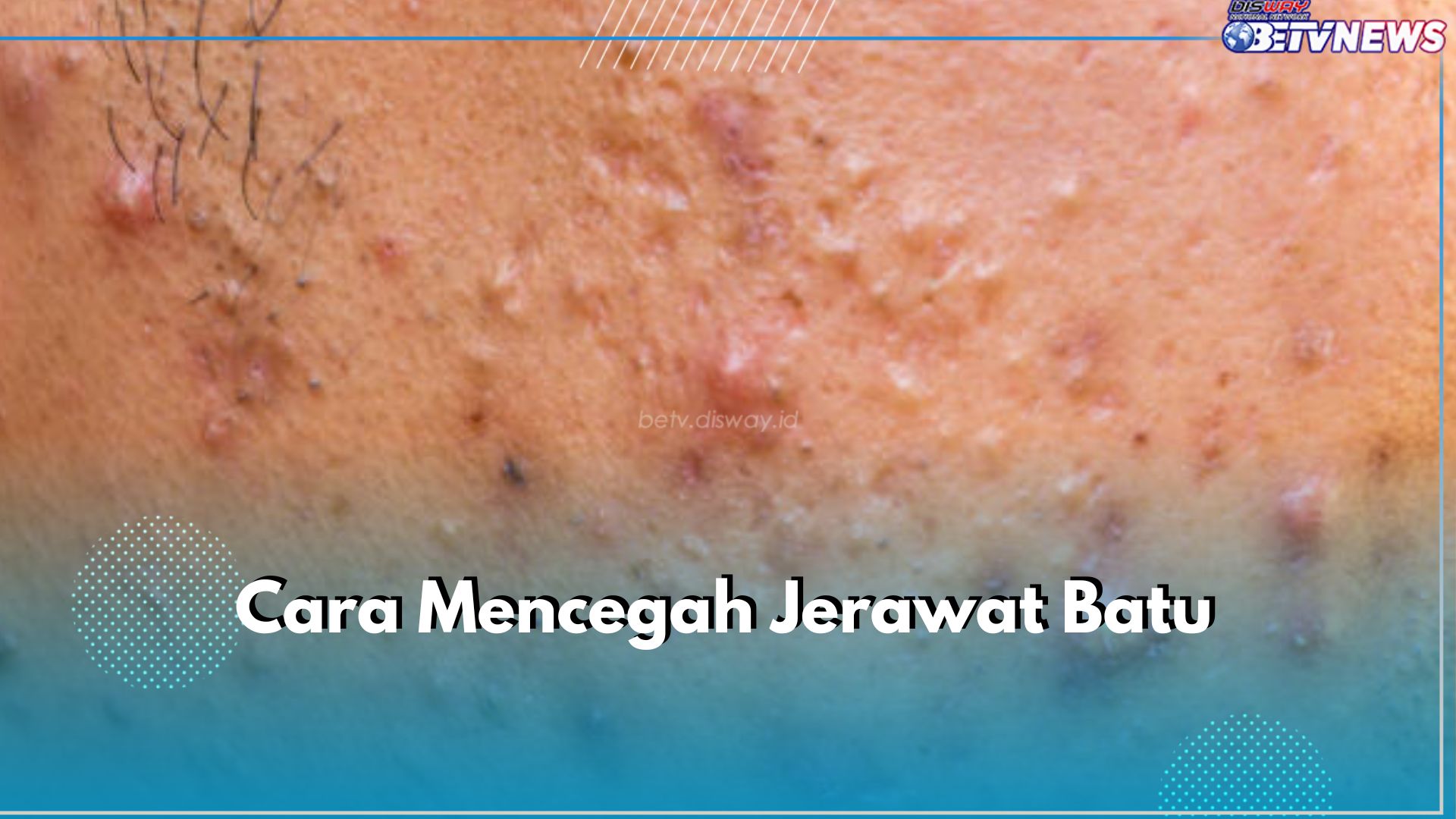 Jangan Sampe Nyesel! Intip 5 Cara Cegah Jerawat Batu di Wajah Ini dan Lakukan Sebelum Terlambat