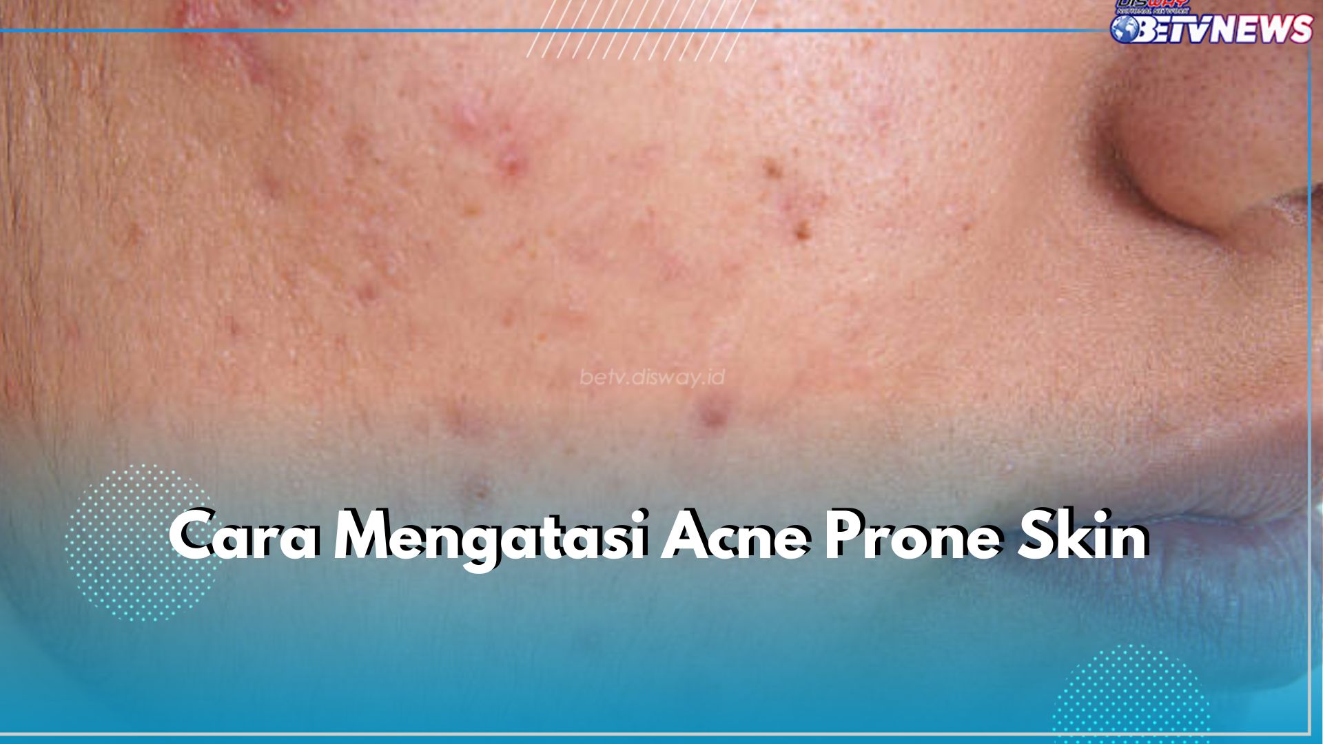 6 Cara Atasi Acne Prone Skin, Pilih Produk Perawatan Non Komedogenik