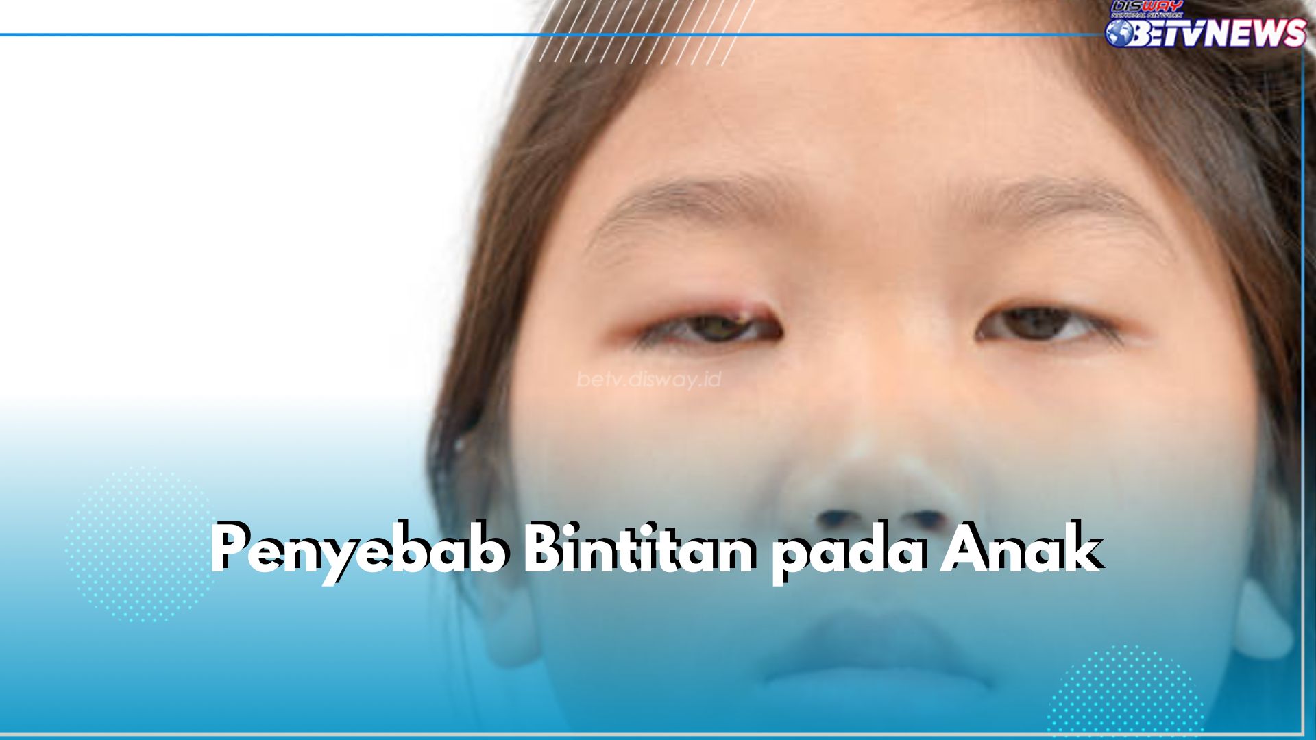 Anak Alami Bintitan? Ini 6 Kemungkinan Penyebabnya, Wajib Tahu Bun!