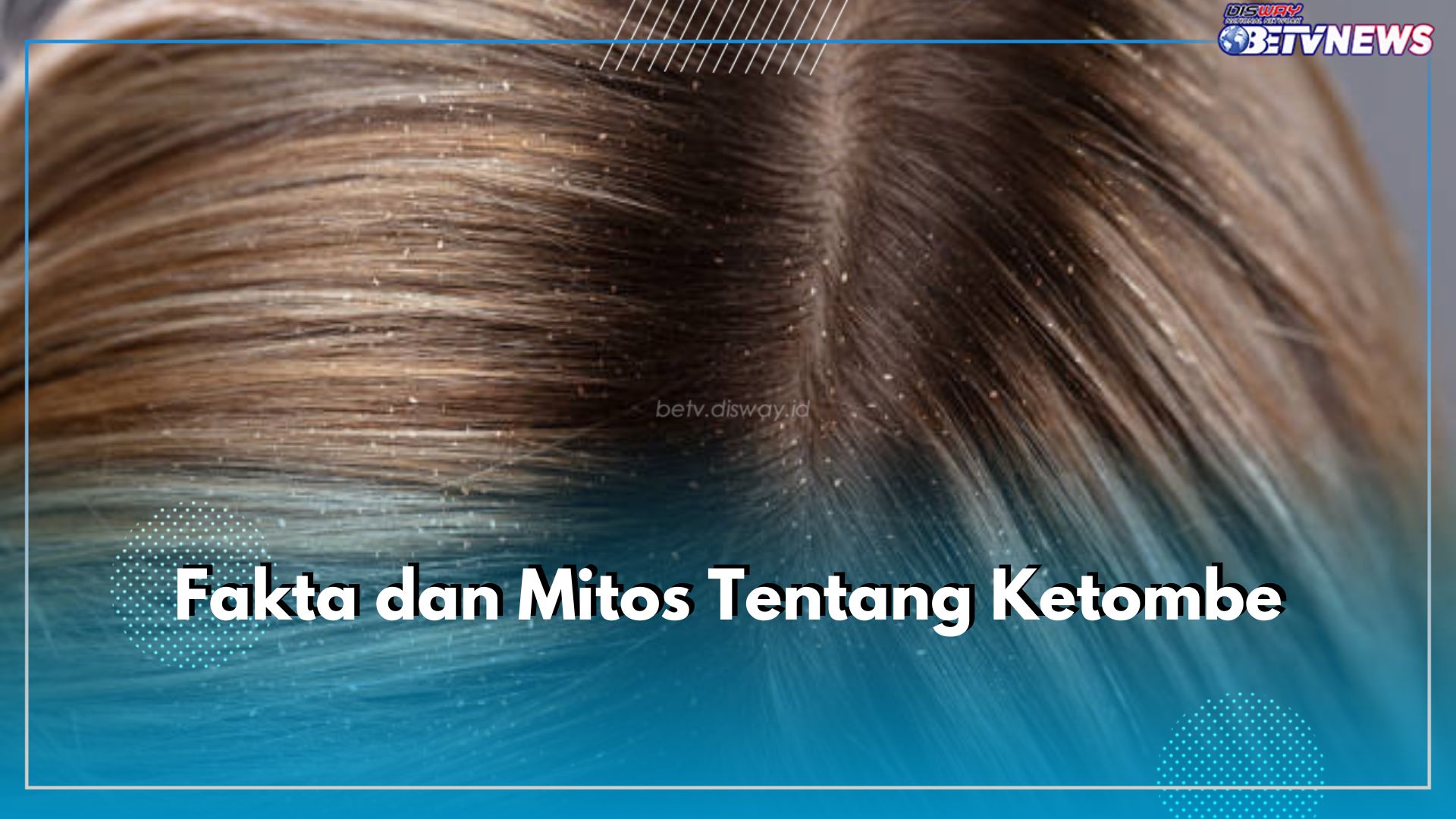 5 Fakta dan Mitos Soal Ketombe yang Jarang Diketahui, Pernah Dengar yang Mana?