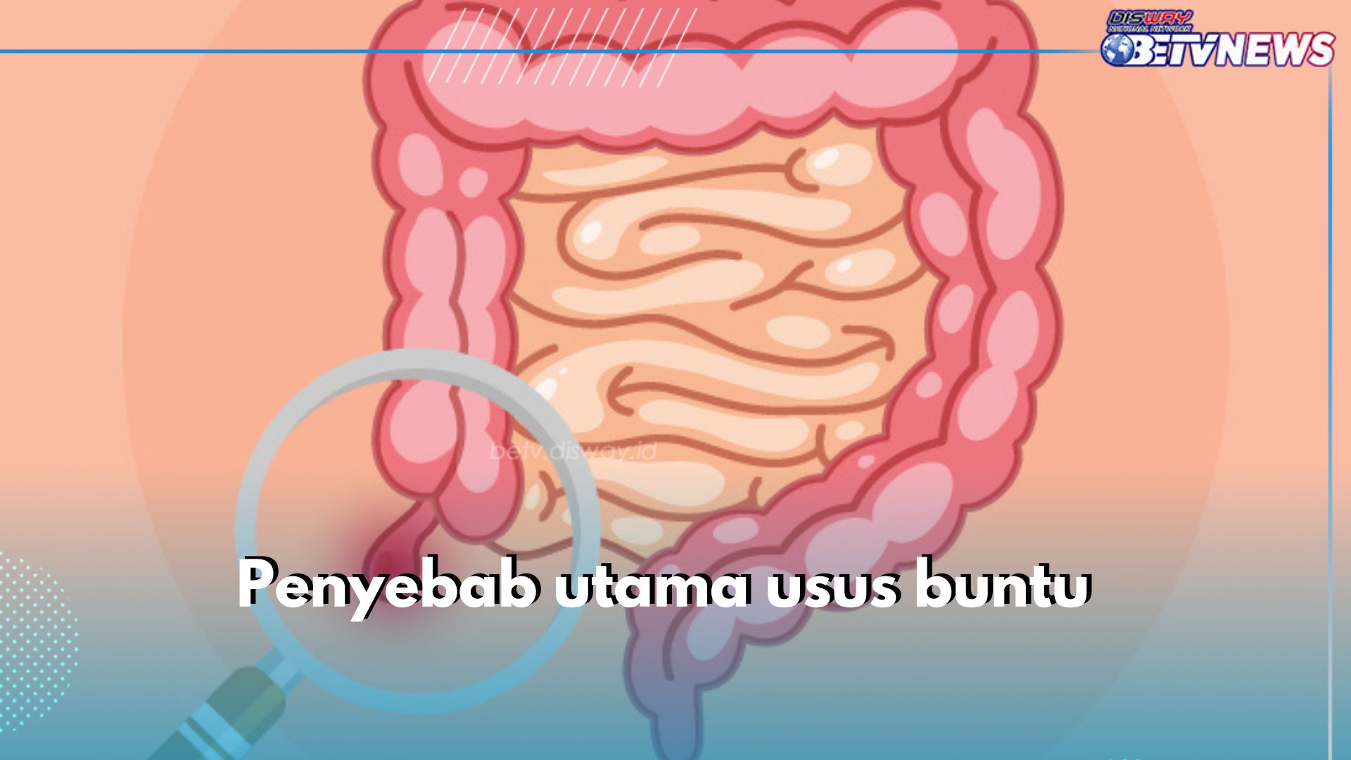 Ini 5 Penyebab Utama Usus Buntu, Salah Satunya Kotoran yang Mengeras