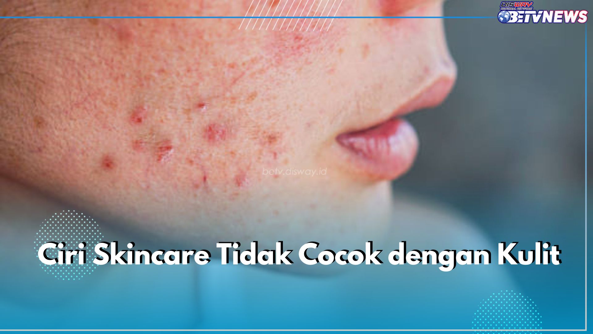 Jangan Abaikan! Ini 7 Ciri Skincare Tak Cocok dengan Kulit, Bisa Bikin Breakout