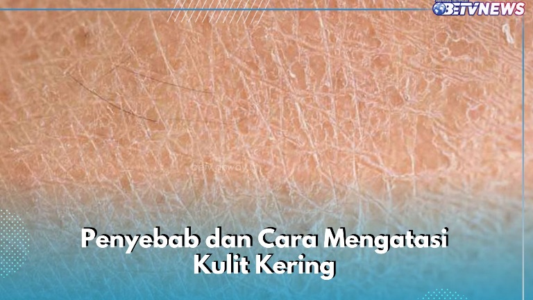 Ini Penyebab Kulit Menjadi Kering, Sebisa Mungkin Hindari, Cek Cara Mengatasi di Sini
