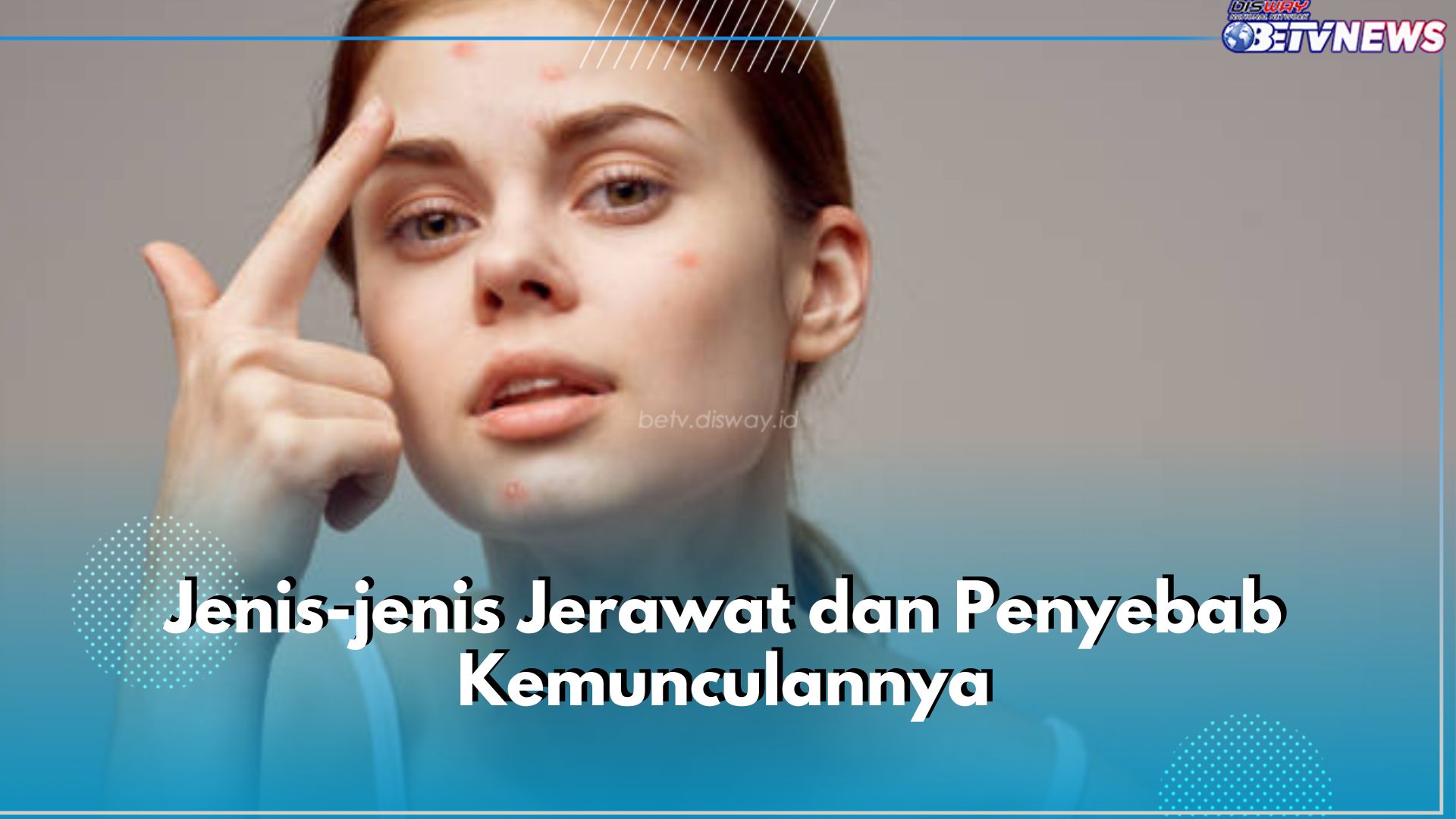 Wajib Tahu! Ini Jenis-jenis Jerawat dan Penyebabnya, Ketahui Segera untuk Perawatan yang Tepat