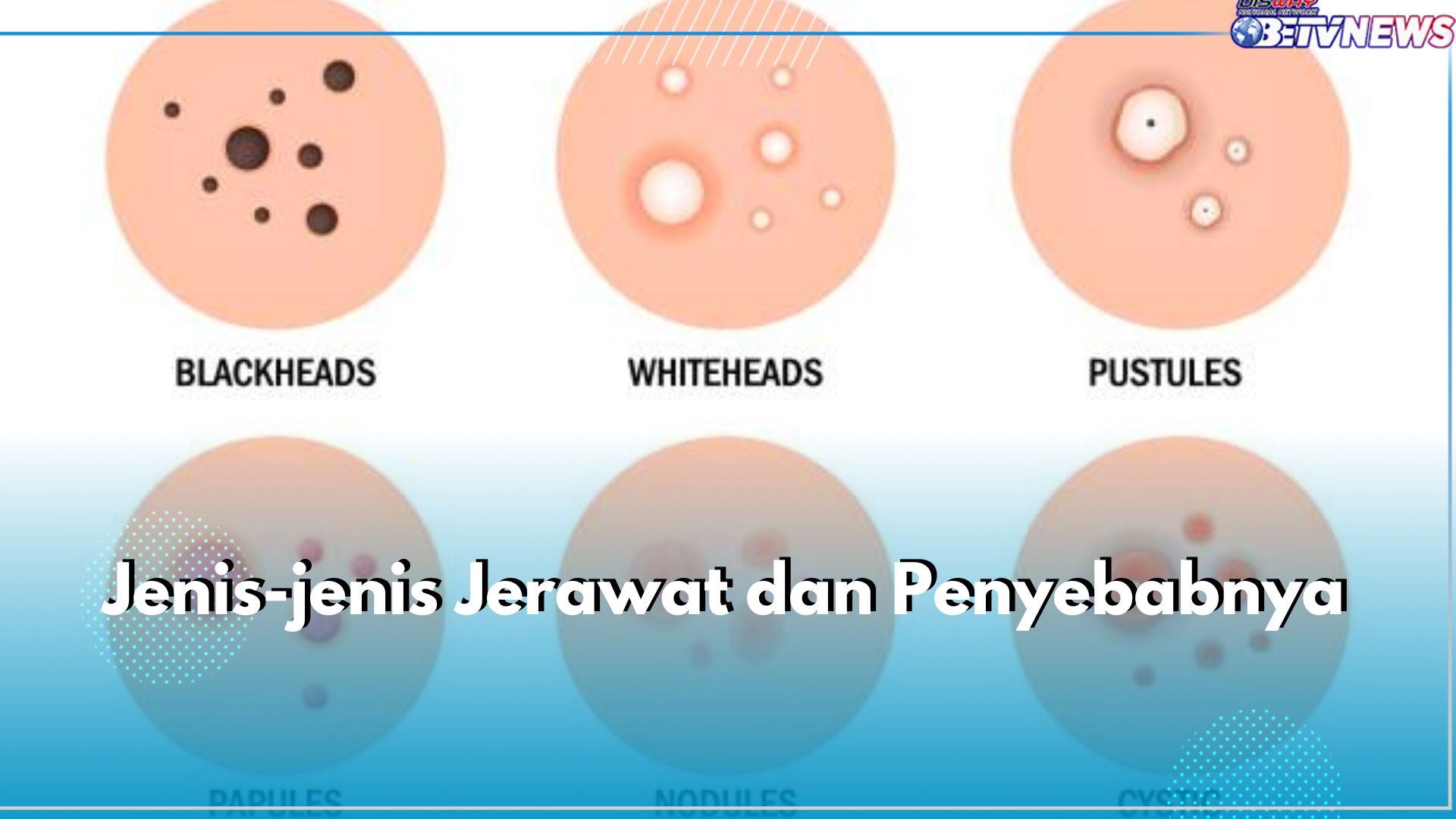 Ketahui Jenis-jenis Jerawat Ini dan Singkap Penyebabnya, Ada Jerawat Komedo hingga Jerawat Nodul