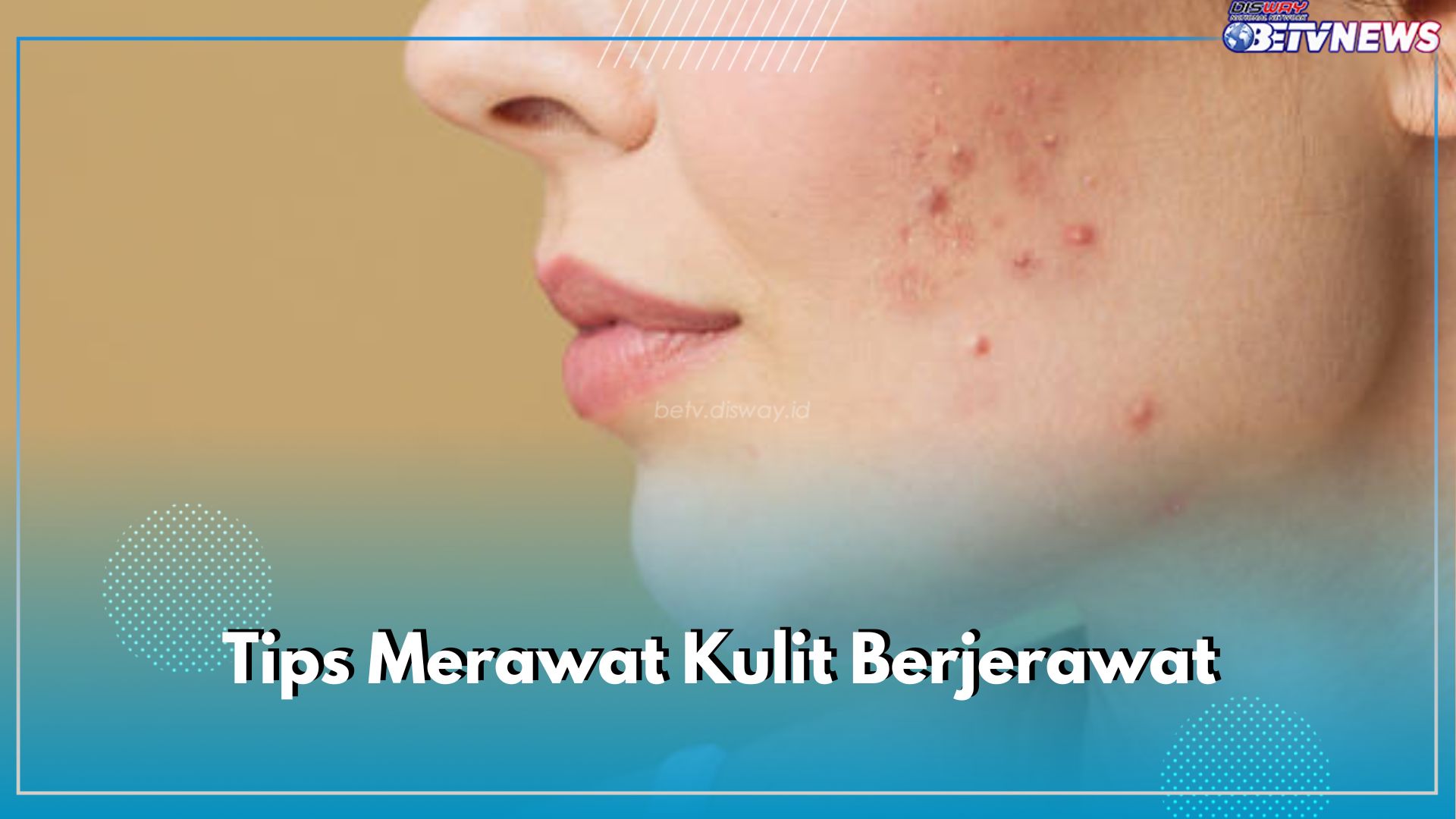 Ini 5 Tips Merawat Kulit Berjerawat Agar Tidak Semakin Banyak, Mulai dari Mencuci Muka Hingga Mengelola Stress