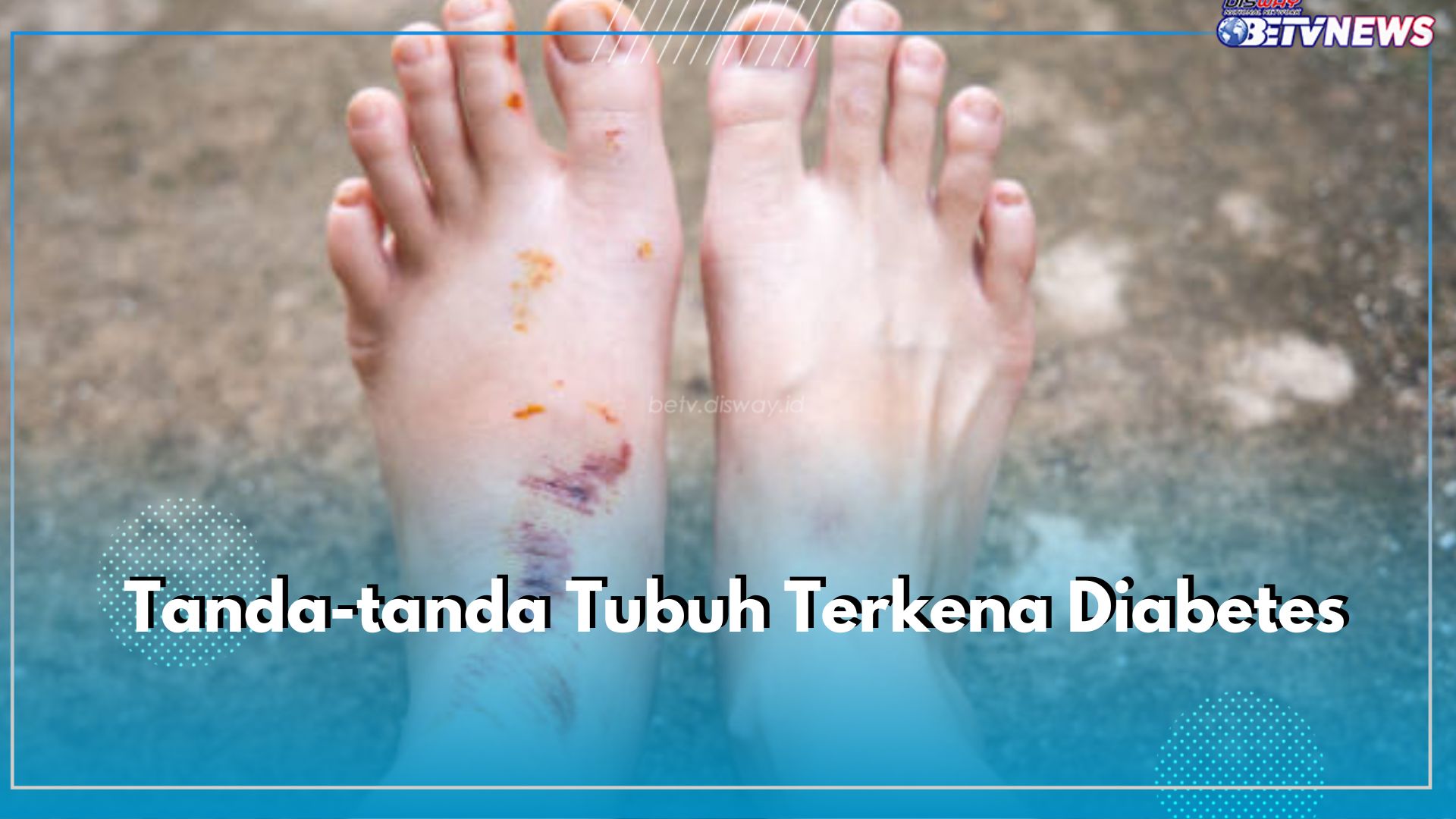 Punya Luka Tapi Susah Kering? Bisa Jadi Terkena Diabetes, Cek Tanda-tanda Lainnya di Sini