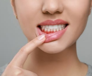 Cara Mudah Mengatasi Sariawan agar Cepat Mereda, Coba Lakukan Hal Ini