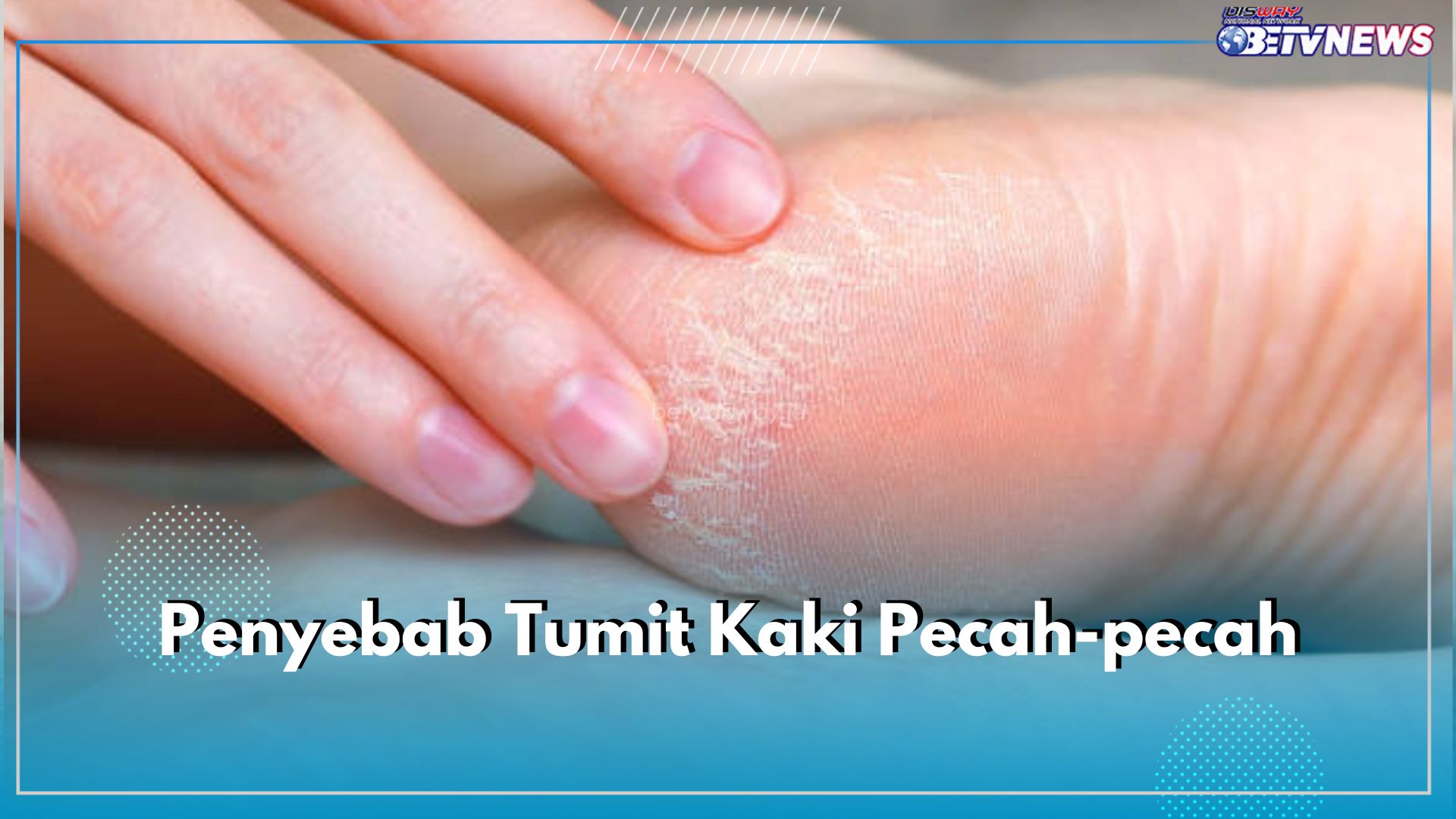 Ternyata Ini 5 Penyebab Tumit Kaki Pecah-Pecah, Salah Satunya Kulit Kering