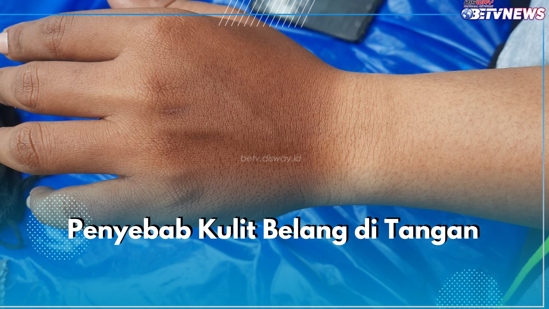 Kulit Tanganmu Belang? Ini 5 Kemungkinan Penyebabnya, Nomor 1 Paling Sering Terjadi