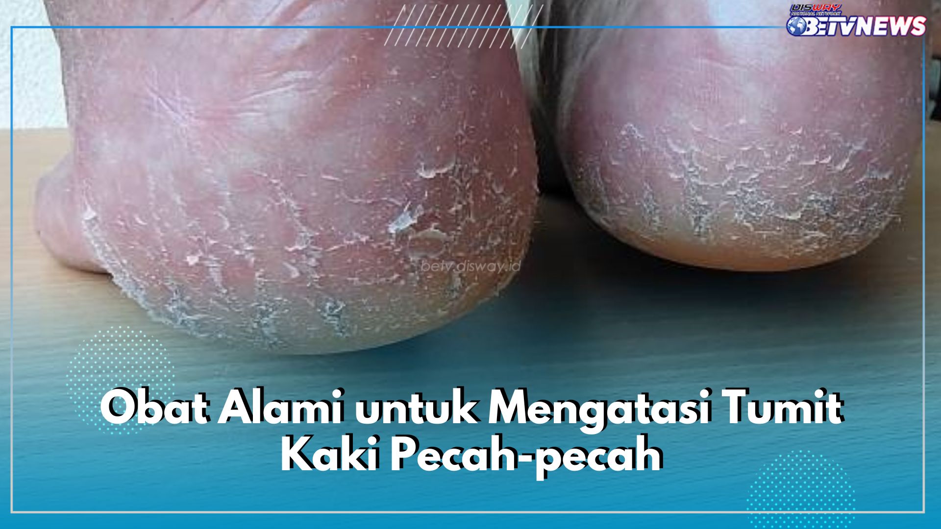 6 Obat Alami Ini Ampuh untuk Atasi Tumit Kaki Pecah-Pecah, Salah Satunya Minyak Kelapa