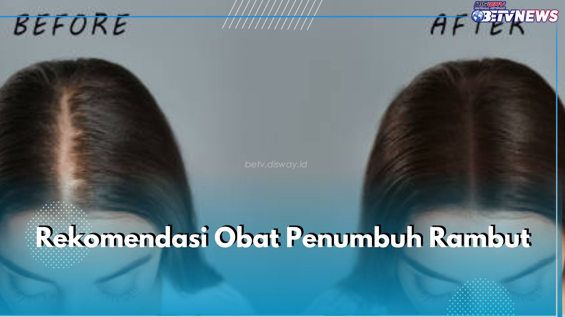 Halau Kebotakan dengan 5 Rekomendasi Obat Penumbuh Rambut Ini, Salah Satunya Minoxidil 