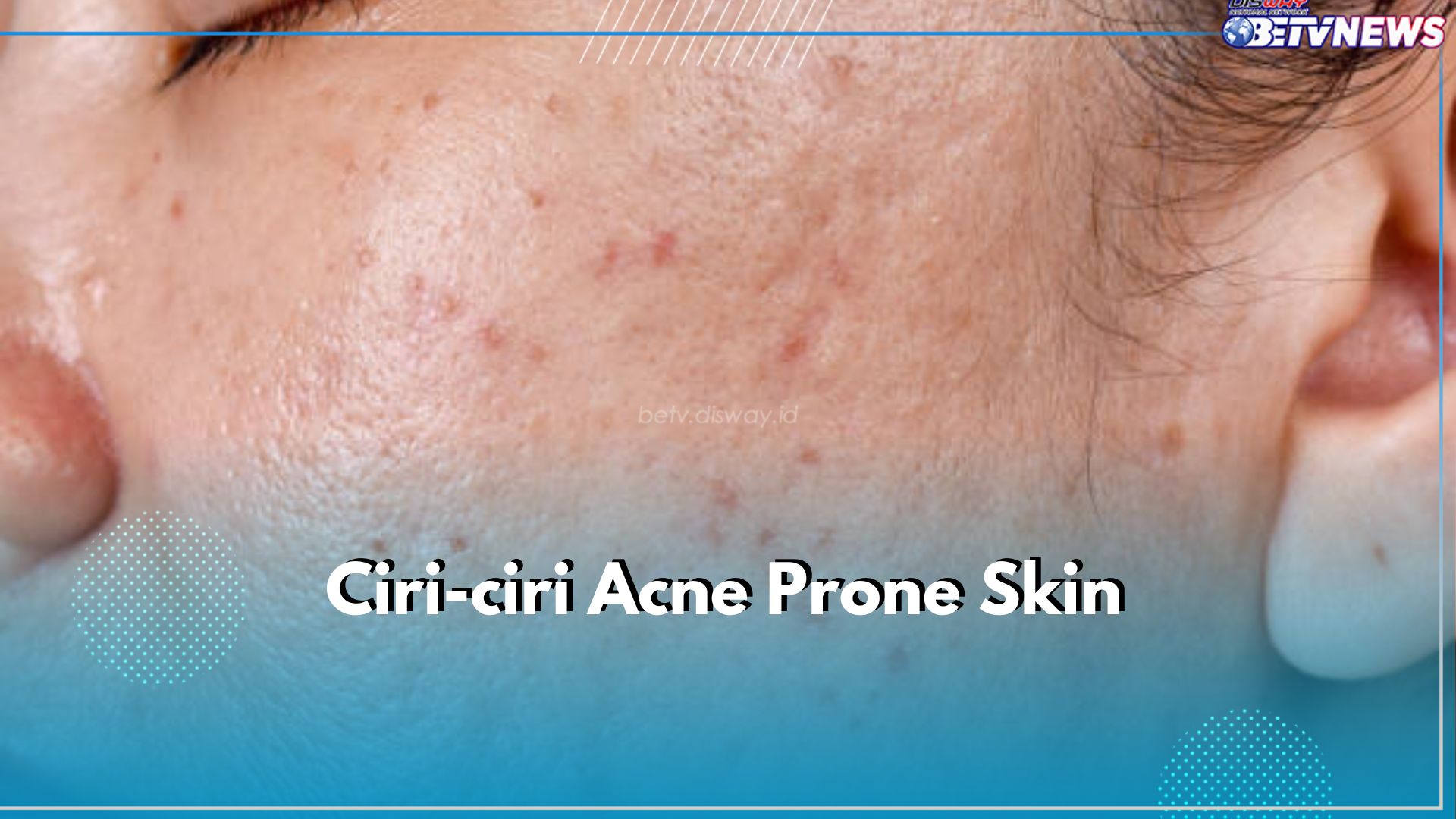 Ini 6 Ciri Acne Prone Skin yang Perlu Kamu Ketahui, Salah Satunya Pori-pori Besar