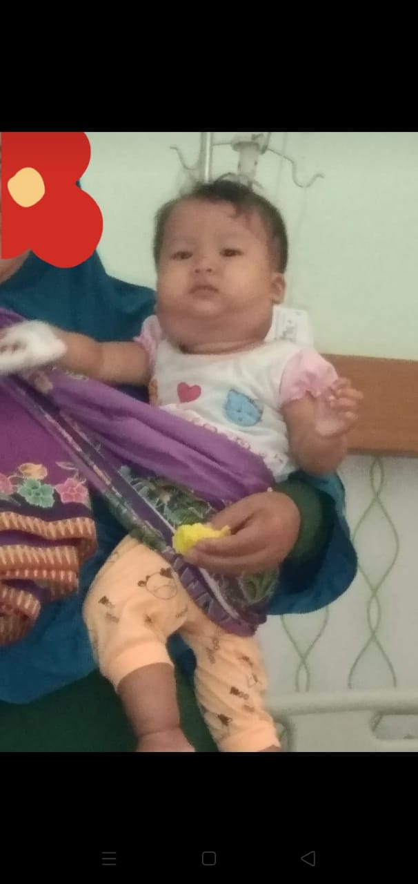 Idap Kelenjar Getah Bening, Bayi 11 Bulan Warga Sukaraja Seluma Butuh Uluran Tangan