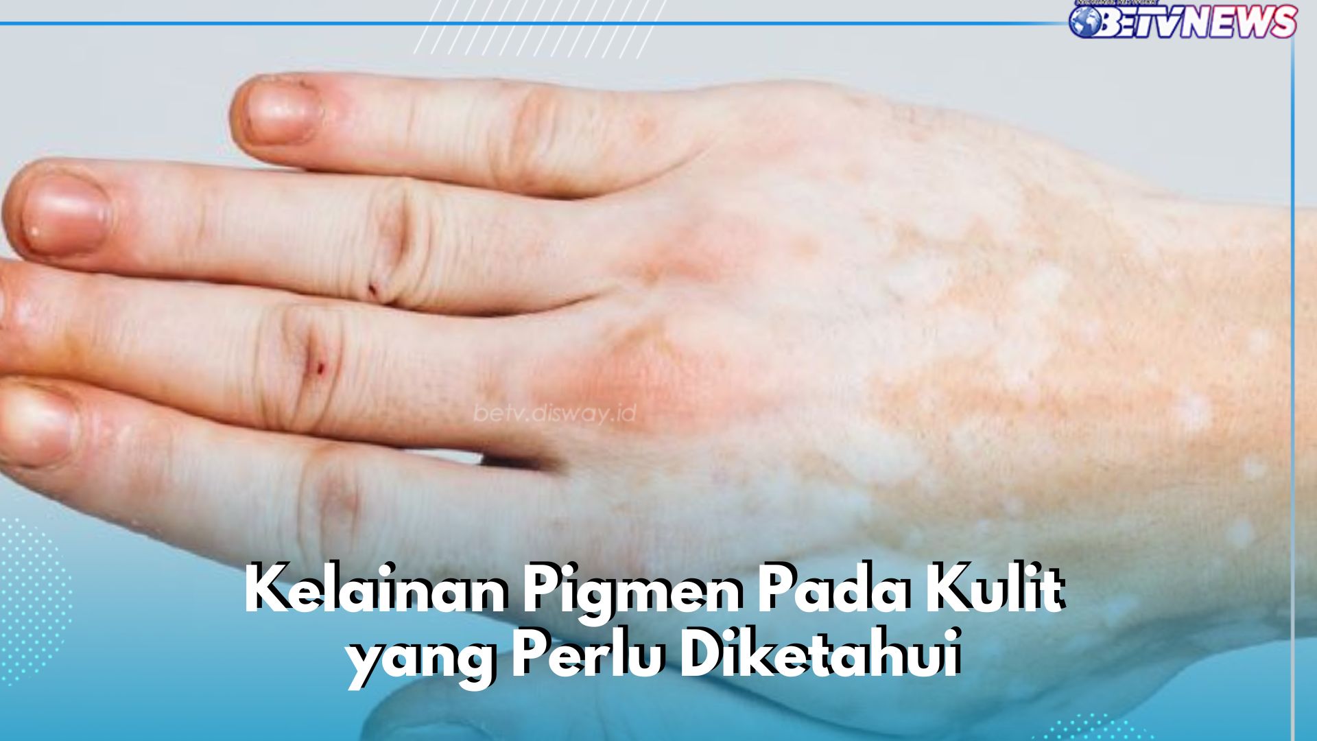 Mengenal Kelainan Pigmen Pada Kulit, Ada Sebutan Albinisme, Cek di Sini