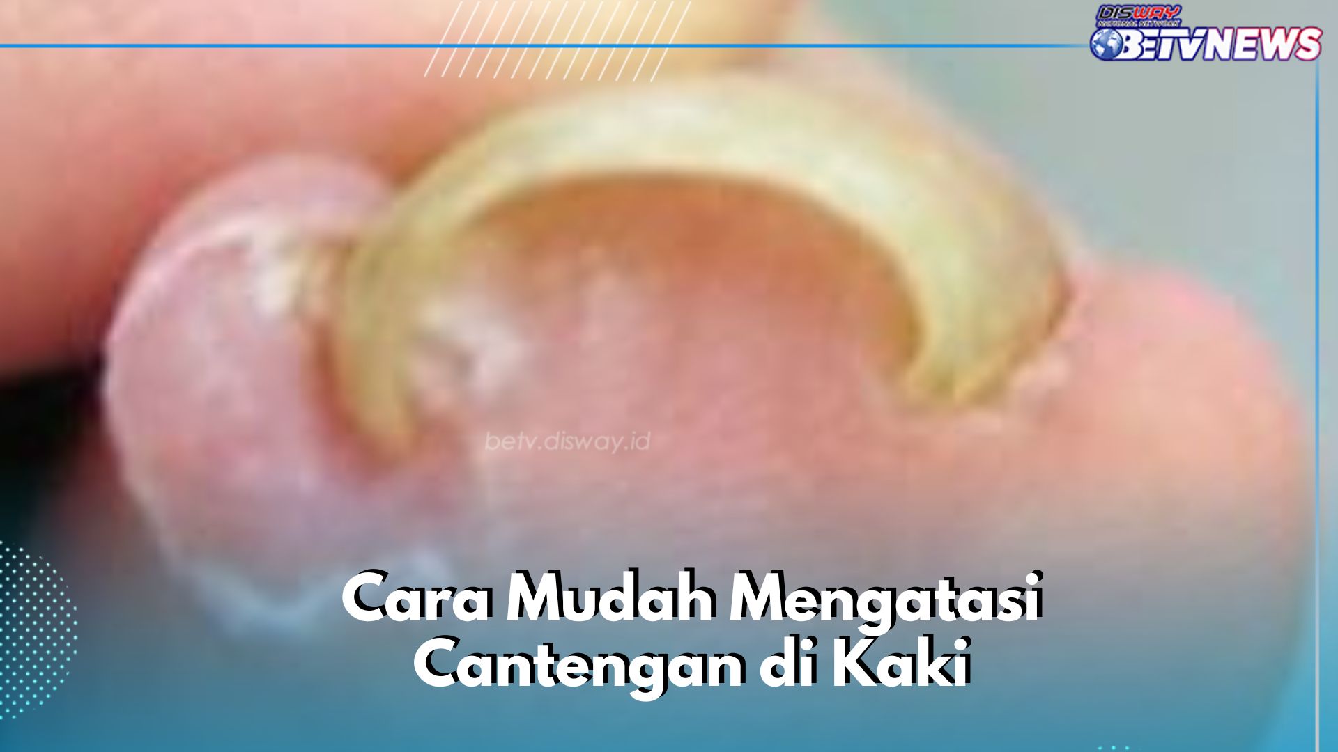 Ini Cara Mudah Mengatasi Cantengan Kuku, Bisa Pakai Obat Antiseptik