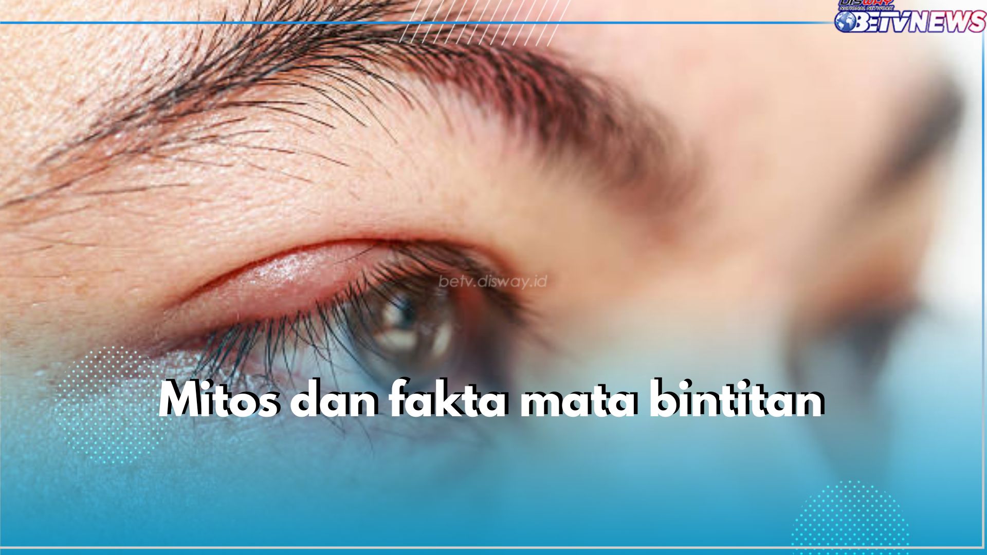 5 Mitos dan Fakta Soal Bintitan, Benarkah Karena Suka Ngintip? Cek Jawabannya di Sini!