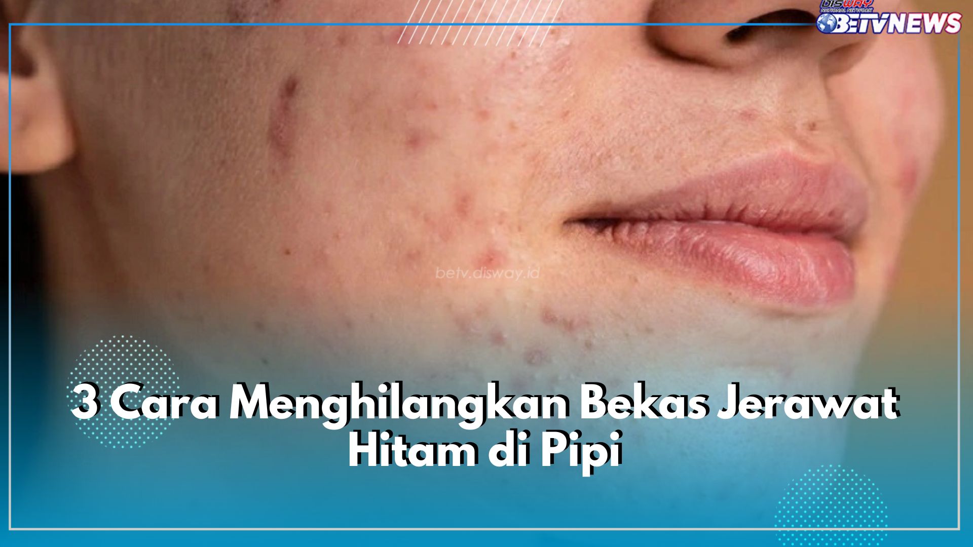 3 Cara Menghilangkan Bekas Jerawat Hitam di Pipi, Manfaatkan Buah Stroberi!