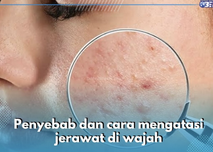 Bakteri Menjadi Salah Satu Penyebab Jerawat di Wajah, Yuk Atasi dengan Cara Ini