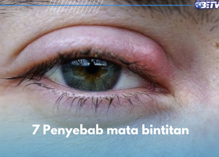 Ini 7 Penyebab Mata Bintitan, Infeksi Akut Kelenjar Minyak hingga Kurang Tidur