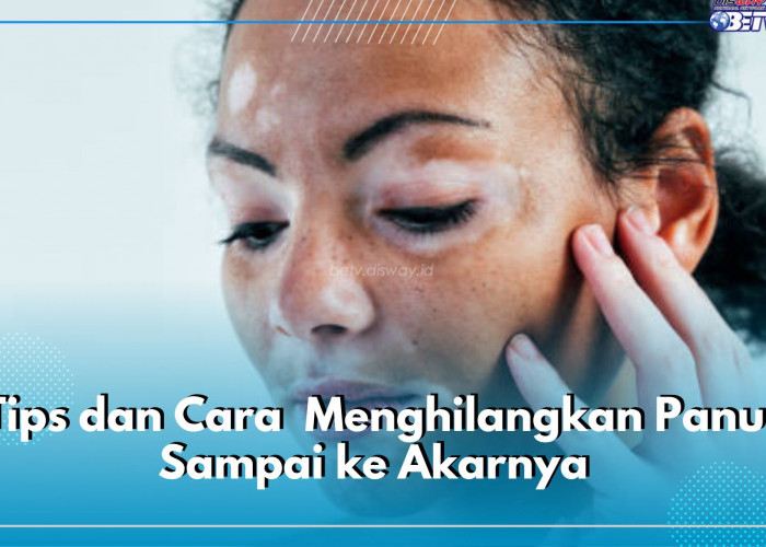 Ini Tips dan Cara Paling Efektif Menghilangkan Panu Sampai ke Akarnya, Dijamin Kulit Mulus Tanpa Bercak