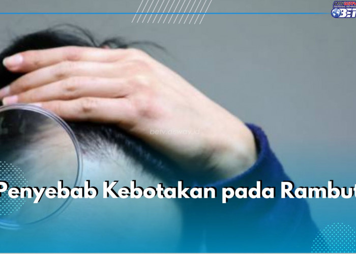 Kenali 7 Penyebab Kebotakan pada Rambut Ini,  Salah Satunya Stres