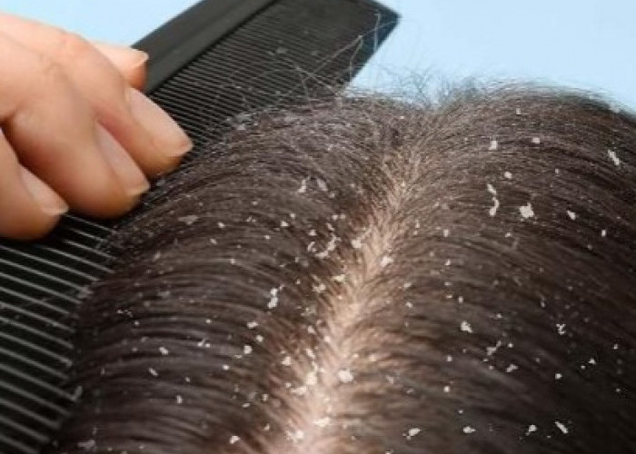 Perlu Tahu! Penyebab Rambut Mudah Ketombean, Salah Satunya Karena Kulit Kepala Berminyak 