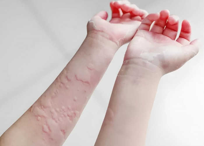 Ada 5 Jenis Obat Herbal yang Dipercaya Ampuh Atasi Biduran