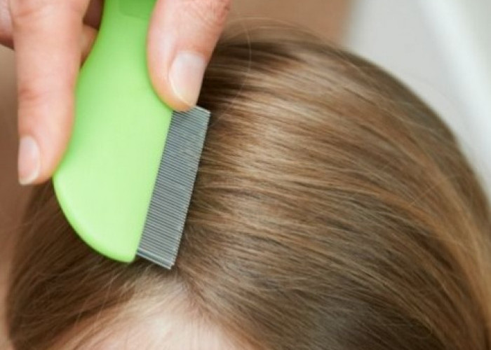 Efektif, Cara Menghilangkan Kutu Rambut yang Jarang Diketahui, Membantu Mencegah Datang Kembali