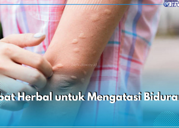 Lidah Buaya hingga Jahe, Ini 5 Jenis Obat Herbal untuk Atasi Biduran Secara Alami