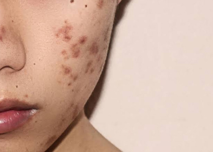 Susah Hilangkan Bekas Jerawat Hitam Dipipi? Coba Gunakan 3 Rekomendasi Masker Ini!