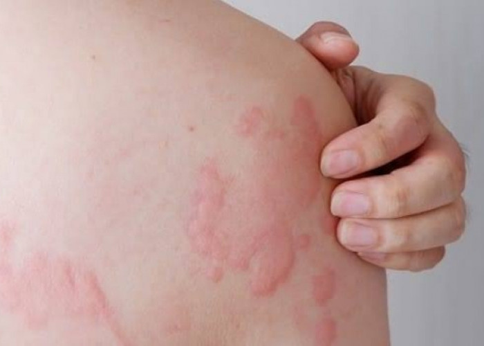 Penderita Biduran Wajib Tahu 5 Obat Herbal yang Ampuh Mengatasi, Cek!