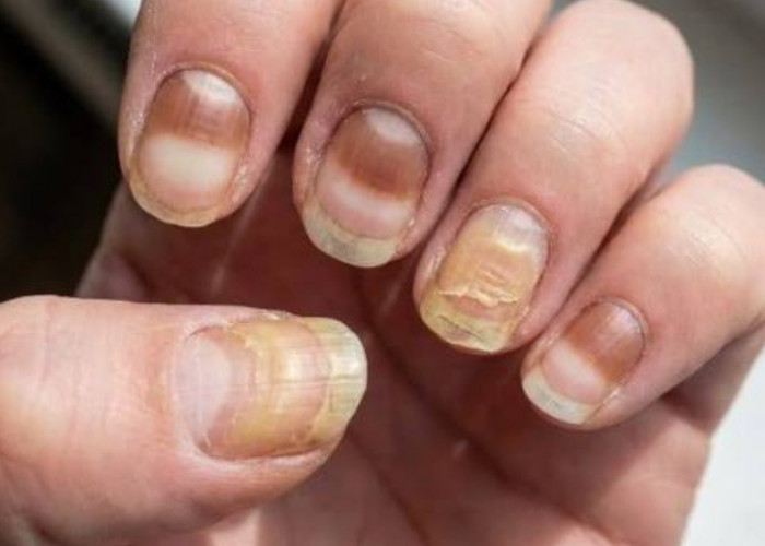 Wajib Tahu! Ini 5 Penyakit Kuku yang Bisa Ganggu Kesehatan Tubuh