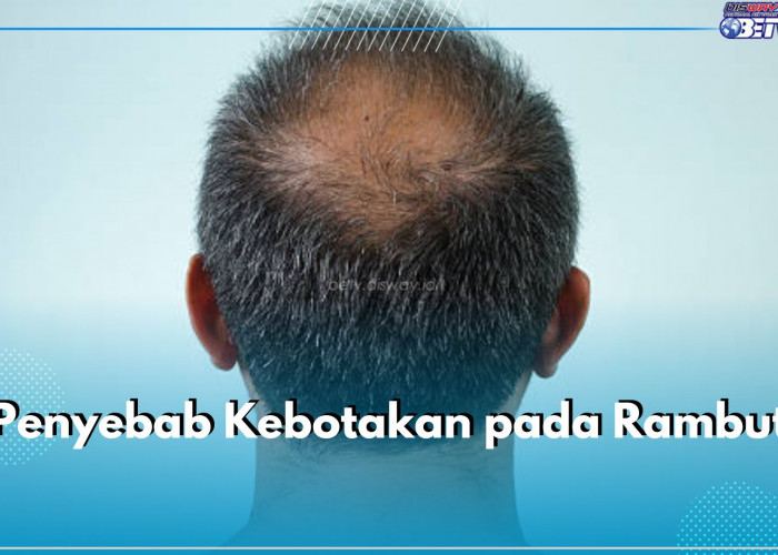 Ini 7 Penyebab Kebotakan pada Rambut yanh Perlu Kamu Ketahui, Ada Faktor Genetik hingga Kebiasaan Merokok