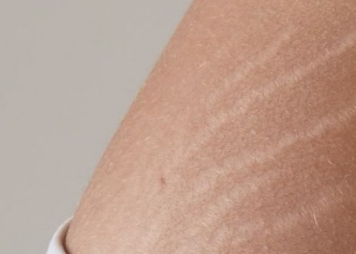 Ini Cara Mengatasi Stretch Mark pada Kulit, Bisa Tampak Lebih Halus