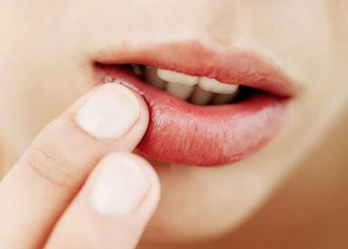 Aman dan Mudah Dilakukan, Cara Mengatasi Bibir Bengkak yang Perlu Diketahui 
