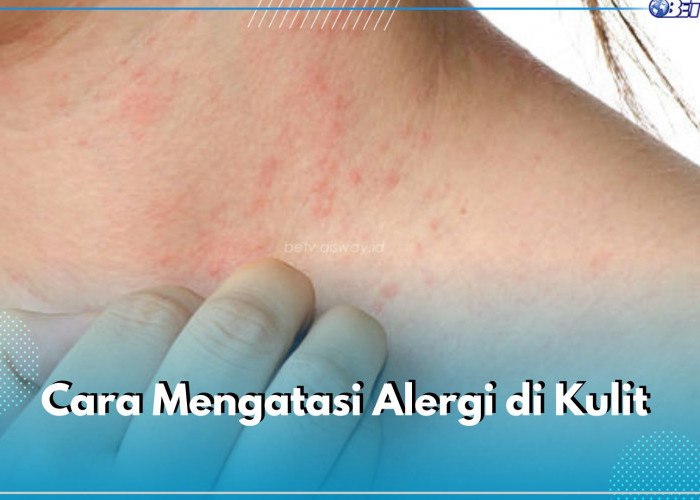 Alami Alergi di Kulit? Atasi Segera dengan 5 Cara Ini, Salah Satunya Gunakan Antihistamin 