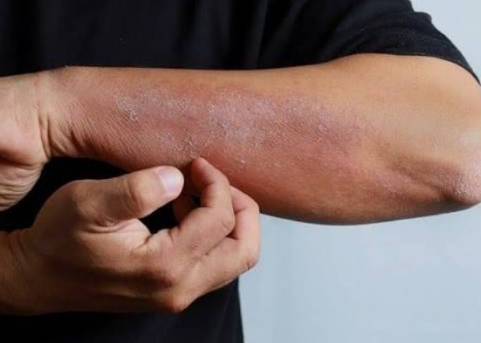Kulit Kering Bisa Diatasi dengan Makanan Tinggi Kandungan Vitamin, Cek Daftarnya Disini!